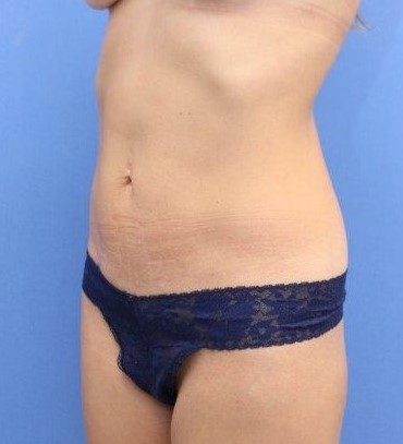 Liposuction Before & After Patient #597