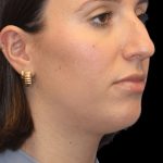 Primary Rhinoplasty Before & After Patient #805
