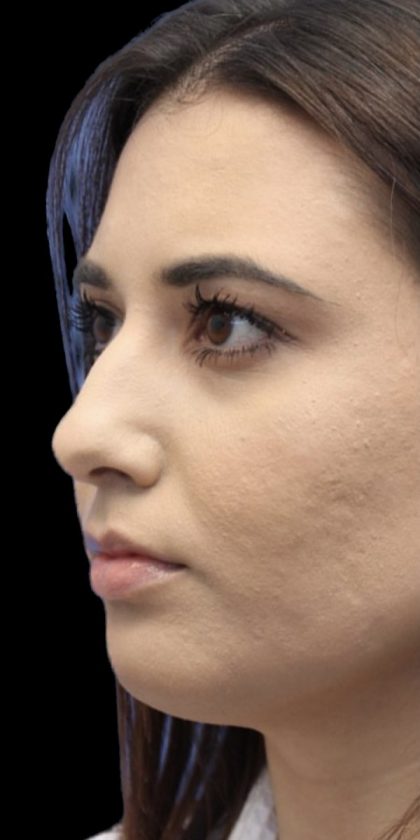 Primary Rhinoplasty Before & After Patient #808