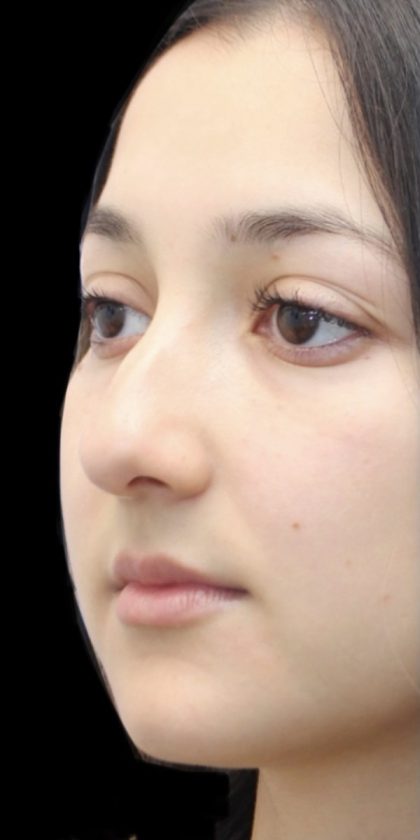 Primary Rhinoplasty Before & After Patient #809