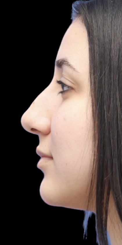 Primary Rhinoplasty Before & After Patient #822
