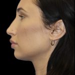 Primary Rhinoplasty Before & After Patient #824