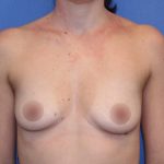 Breast Augmentation Before & After Patient #419