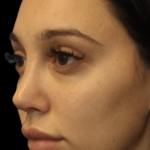 Primary Rhinoplasty Before & After Patient #807