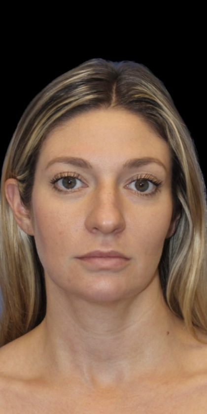 Primary Rhinoplasty Before & After Patient #825