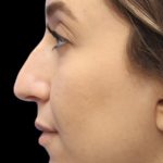 Primary Rhinoplasty Before & After Patient #855