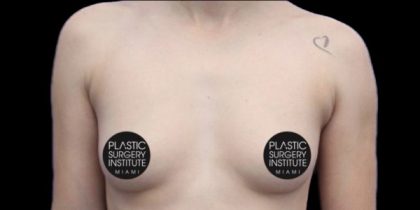Breast Augmentation Before & After Patient #494