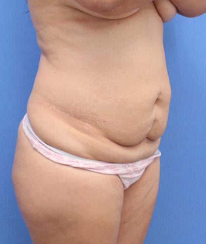 Tummy Tuck Before & After Patient #891