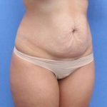 Tummy Tuck Before & After Patient #892