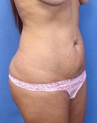 Tummy Tuck Before & After Patient #893