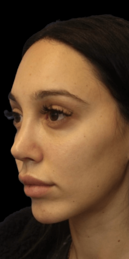 Primary Rhinoplasty Before & After Patient #807