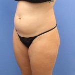 Liposuction Before & After Patient #595