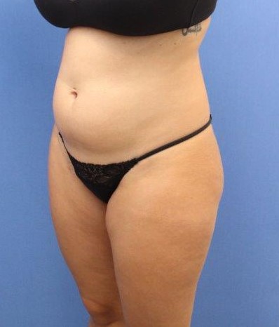 Liposuction Before & After Patient #595