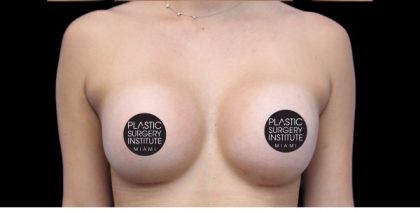 Breast Augmentation Before & After Patient #422