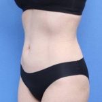 Liposuction Before & After Patient #596