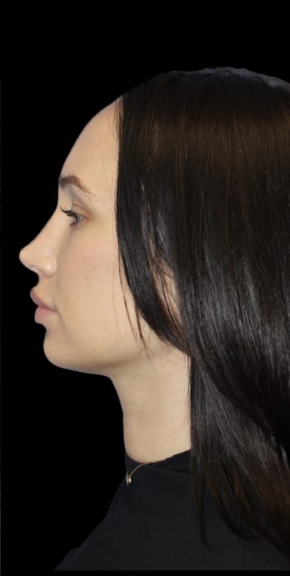 Primary Rhinoplasty Before & After Patient #824