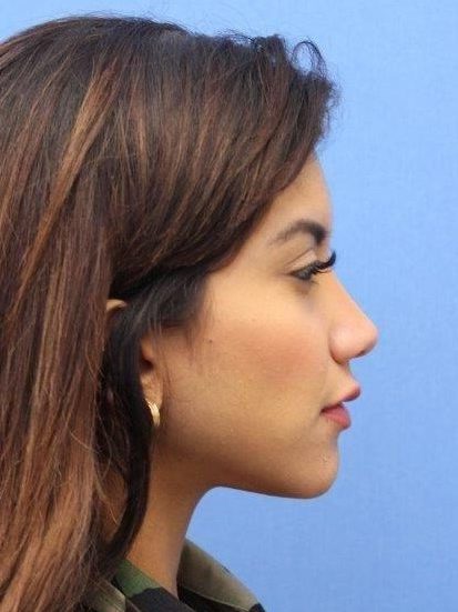 Primary Rhinoplasty Before & After Patient #744