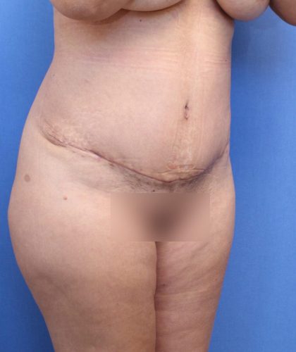 Tummy Tuck Before & After Patient #891