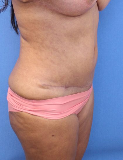 Tummy Tuck Before & After Patient #890