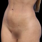 Liposuction Before & After Patient #604