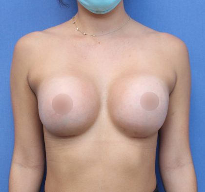 Breast Augmentation Before & After Patient #421