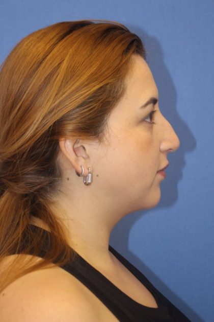 Primary Rhinoplasty Before & After Patient #776