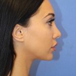 Revision Rhinoplasty Before & After Patient #875
