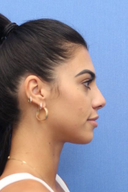 Revision Rhinoplasty Before & After Patient #876