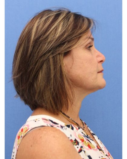 Revision Rhinoplasty Before & After Patient #877