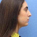 Primary Rhinoplasty Before & After Patient #774