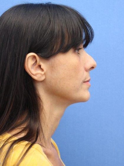 Primary Rhinoplasty Before & After Patient #777