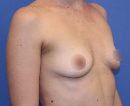 Breast Augmentation Before & After Patient #419