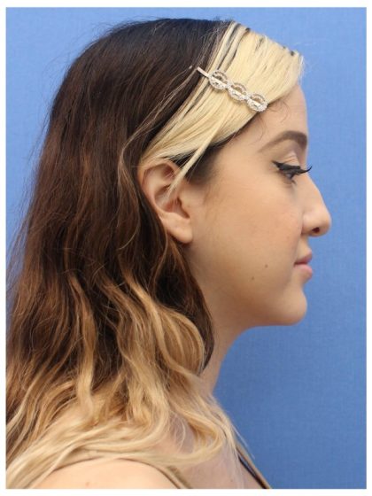 Primary Rhinoplasty Before & After Patient #740