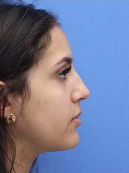 Primary Rhinoplasty Before & After Patient #741