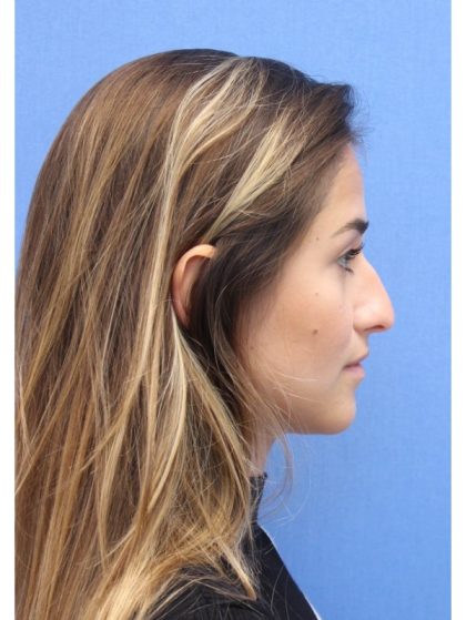 Primary Rhinoplasty Before & After Patient #742