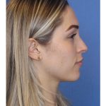 Primary Rhinoplasty Before & After Patient #743
