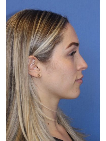 Primary Rhinoplasty Before & After Patient #743