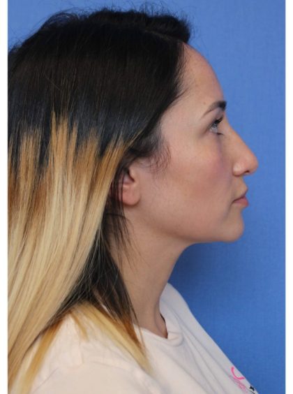 Primary Rhinoplasty Before & After Patient #775