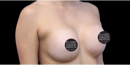 Breast Augmentation Before & After Patient #422