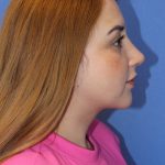 Primary Rhinoplasty Before & After Patient #776