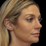 Primary Rhinoplasty Before & After Patient #825