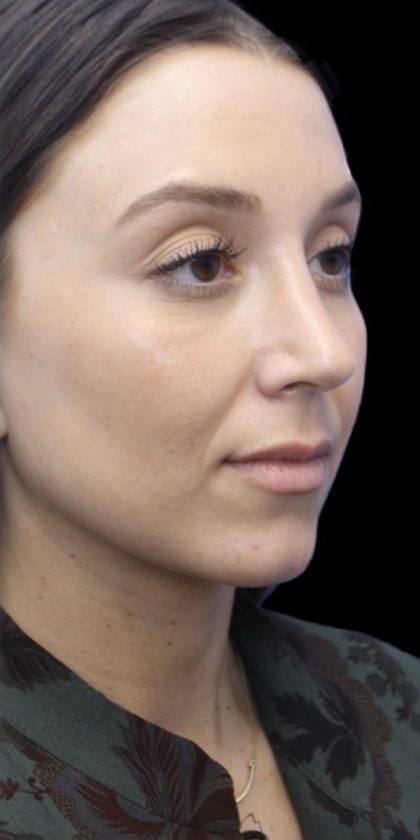 Primary Rhinoplasty Before & After Patient #855