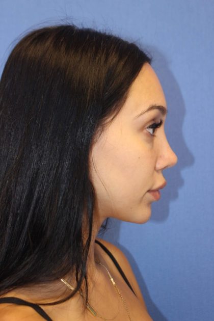 Revision Rhinoplasty Before & After Patient #875