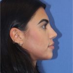 Revision Rhinoplasty Before & After Patient #876