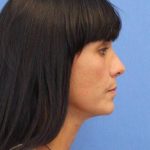 Primary Rhinoplasty Before & After Patient #777