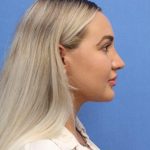 Primary Rhinoplasty Before & After Patient #778