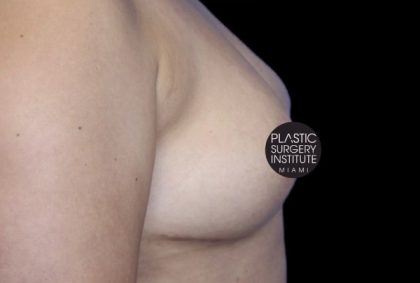 Breast Lift Before & After Patient #538