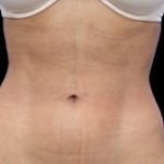 Liposuction Before & After Patient #604