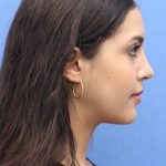 Primary Rhinoplasty Before & After Patient #741