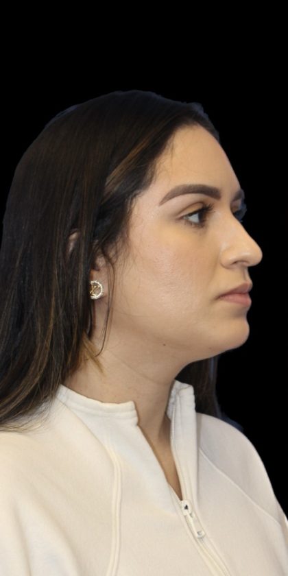 Primary Rhinoplasty Before & After Patient #856